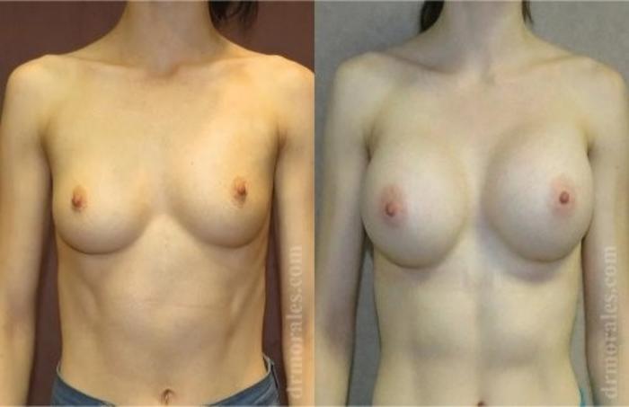 Before & After Breast Augmentation Case 820 View 1 View in Houston, TX