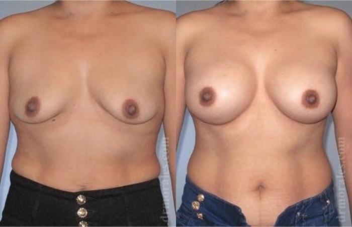 Before & After Breast Augmentation Case 821 View 1 View in Houston, TX