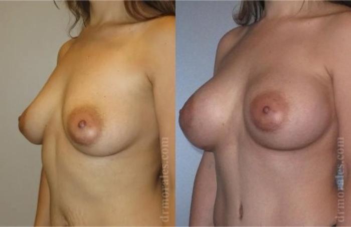 Before & After Breast Augmentation Case 822 View 1 View in Houston, TX