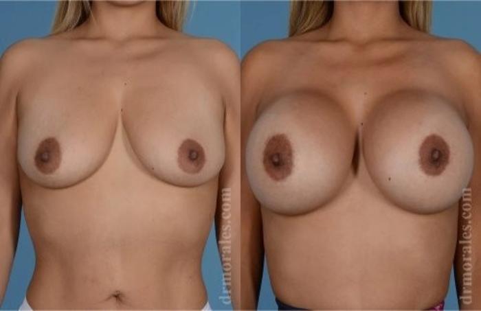Before & After Breast Augmentation Case 823 View 1 View in Houston, TX