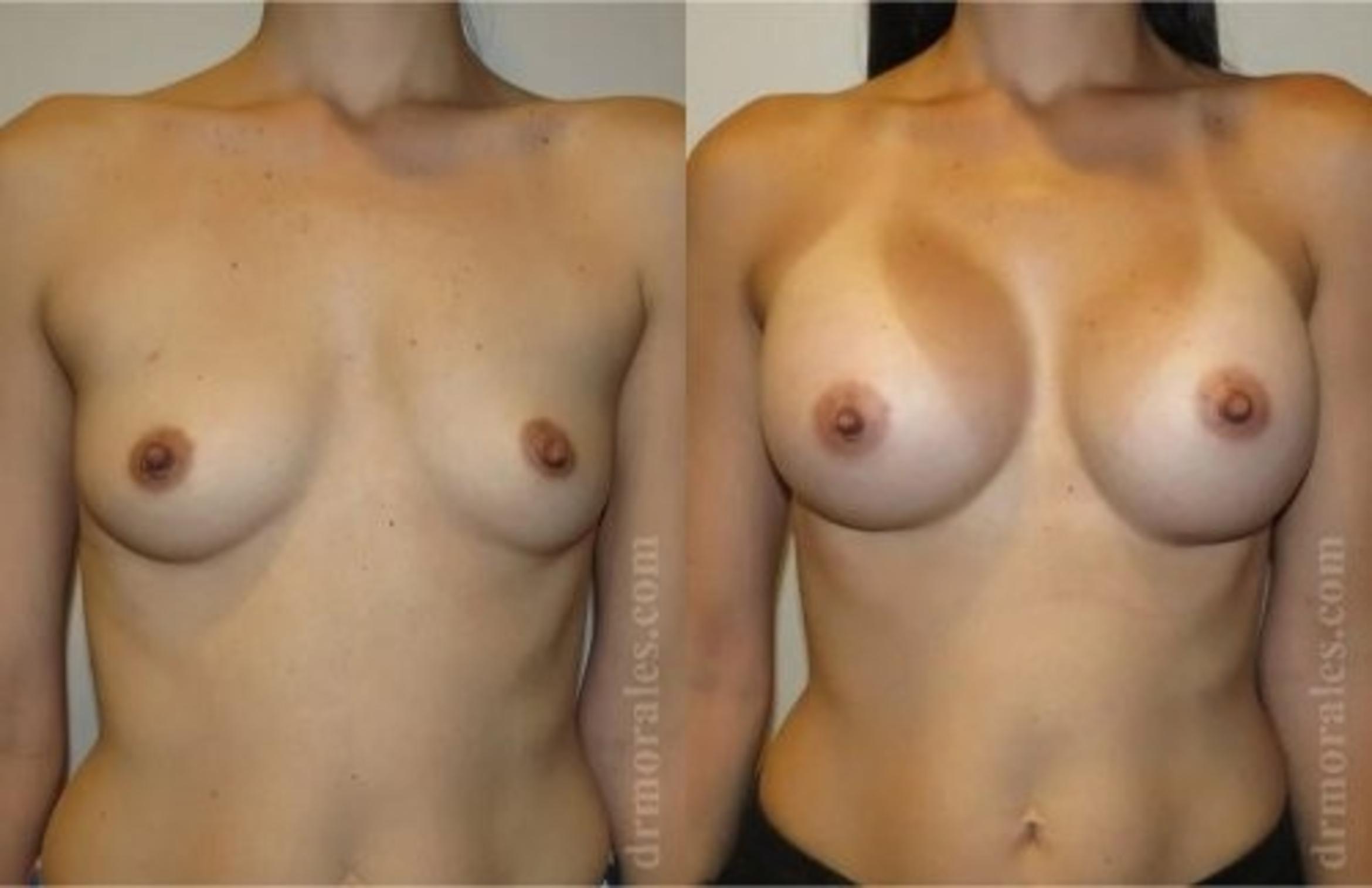 Before & After Breast Augmentation Case 824 View 1 View in Houston, TX