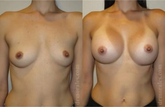 Before & After Breast Augmentation Case 824 View 1 View in Houston, TX