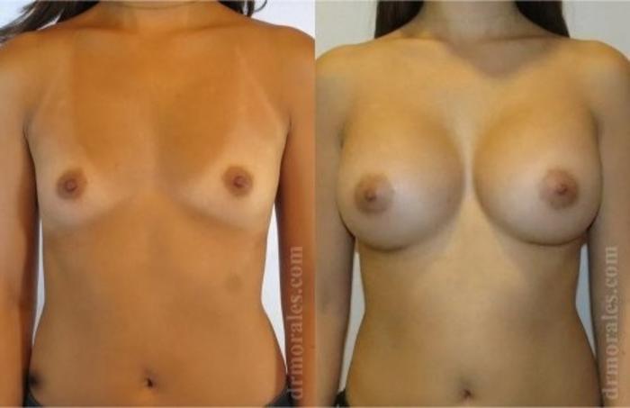 Before & After Breast Augmentation Case 825 View 1 View in Houston, TX