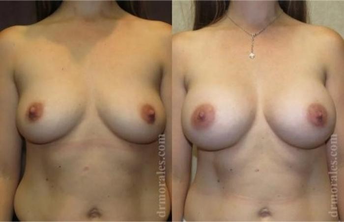 Before & After Breast Augmentation Case 826 View 1 View in Houston, TX
