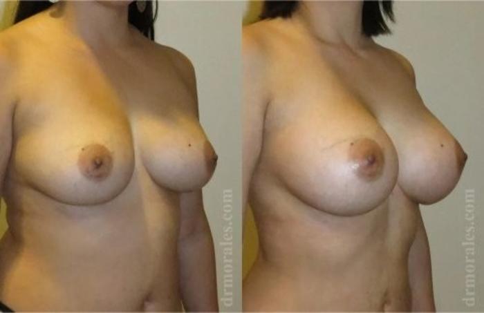 Before & After Breast Augmentation Case 827 View 1 View in Houston, TX