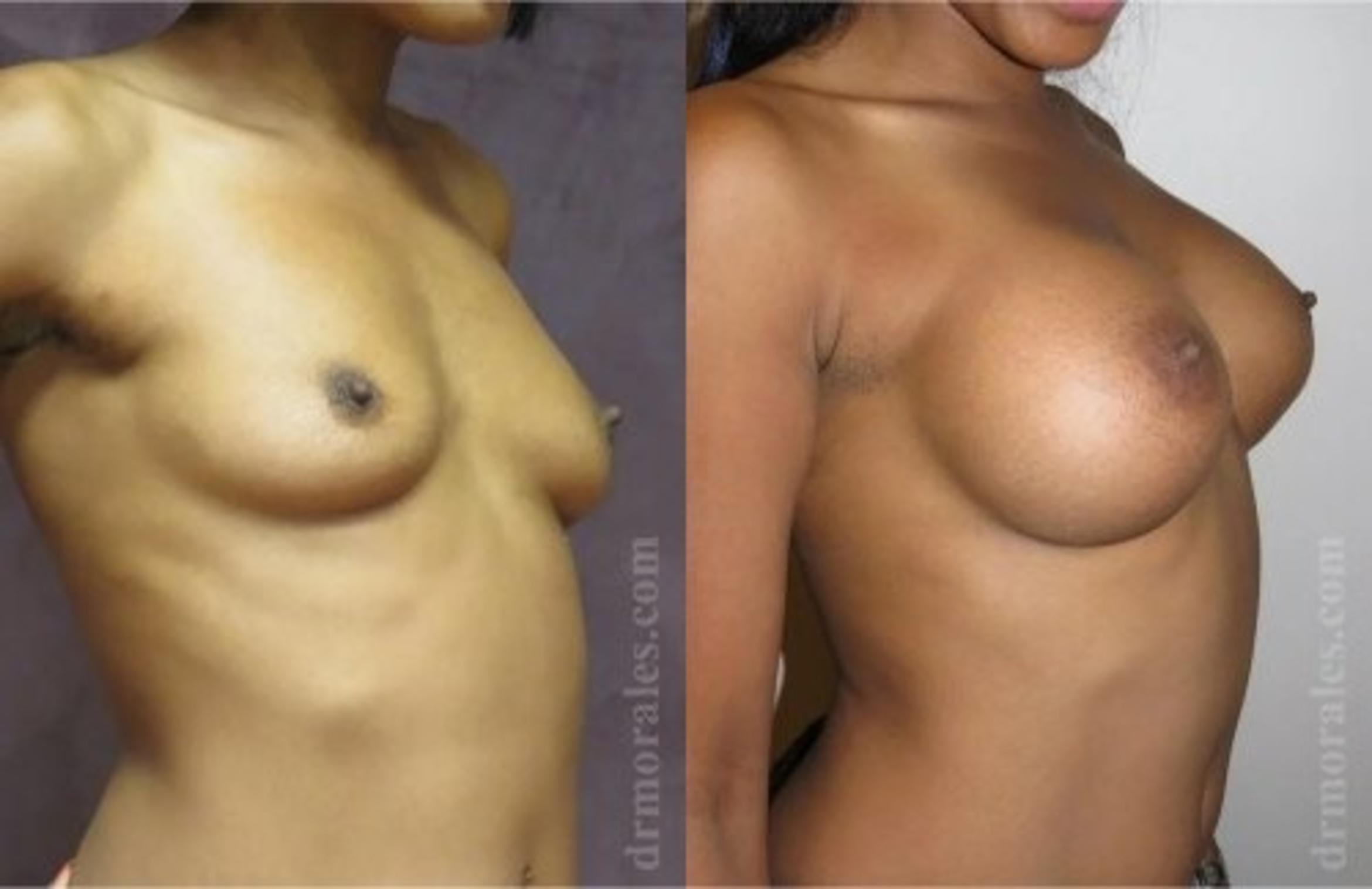 Before & After Breast Augmentation Case 828 View 1 View in Houston, TX