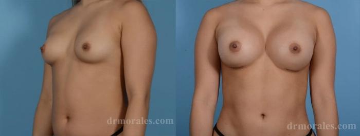 Before & After Breast Augmentation Case 829 View 1 View in Houston, TX