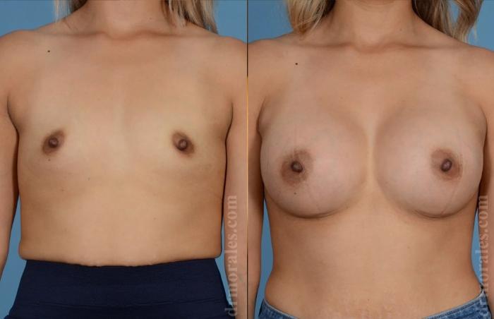 Before & After Breast Augmentation Case 830 View 1 View in Houston, TX