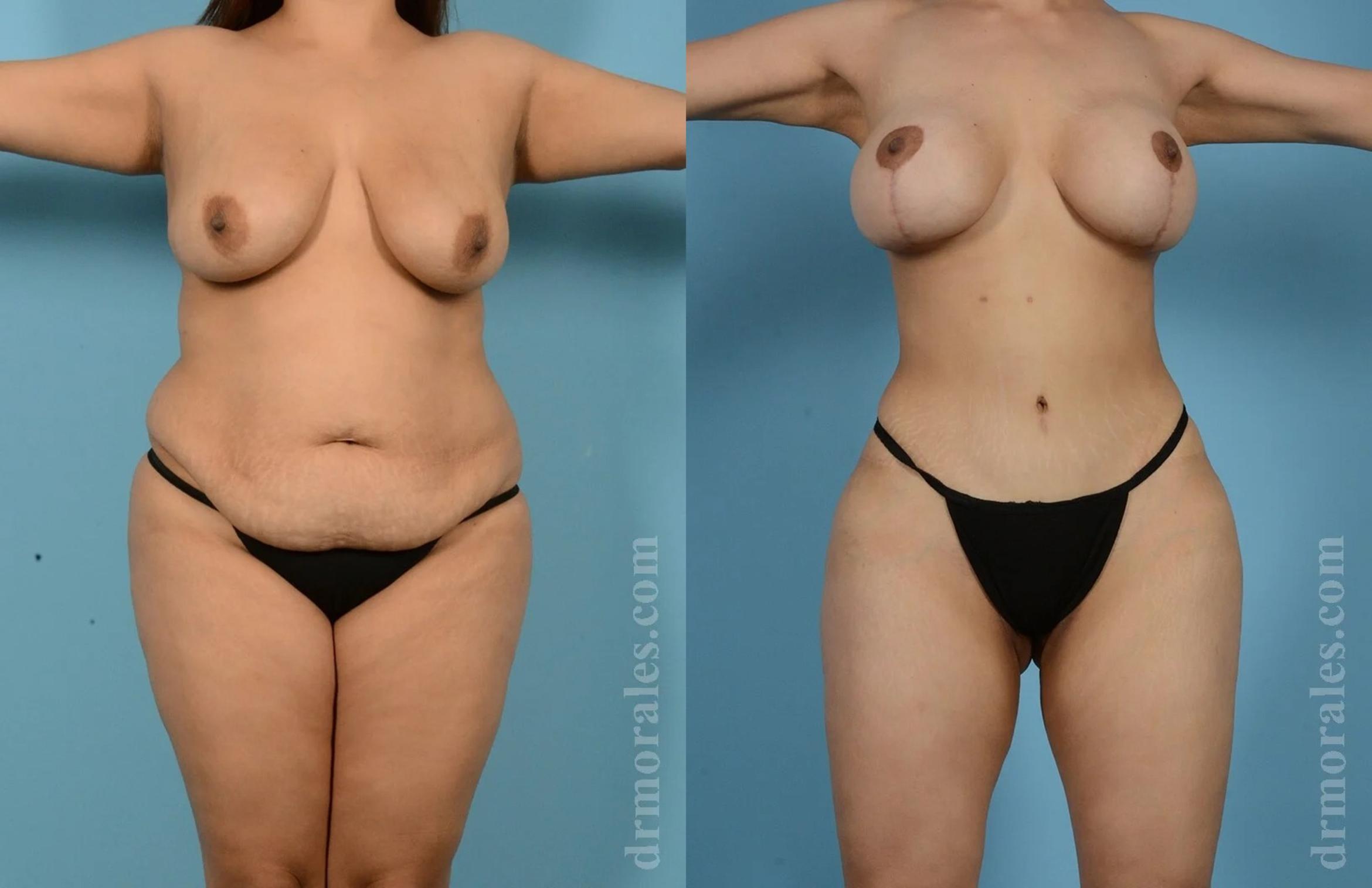 Before & After Liposuction Case 832 View 1 View in Houston, TX