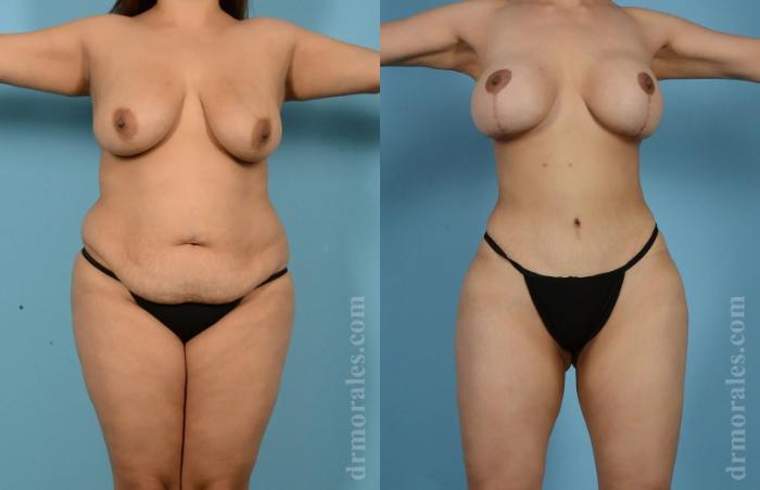 Before & After Liposuction Case 832 View 1 View in Houston, TX