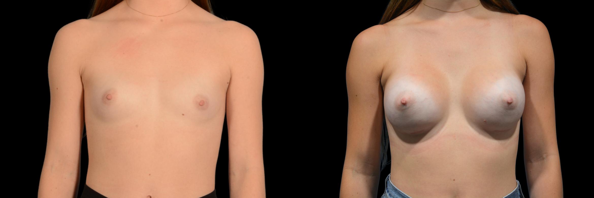 Before & After Breast Augmentation Case 833 Front View in Houston, TX