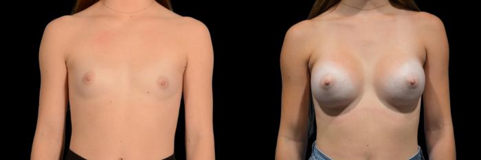 Before & After Breast Augmentation Case 833 Front View in Houston, TX