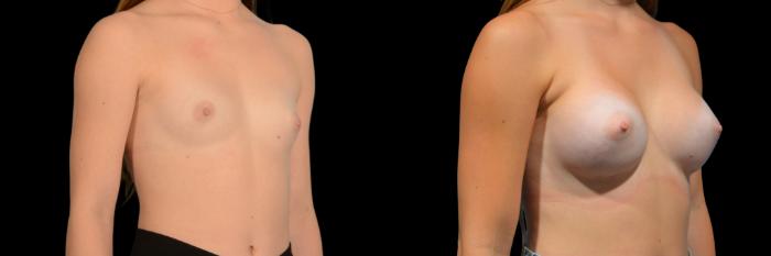 Before & After Breast Augmentation Case 833 Right Oblique View in Houston, TX