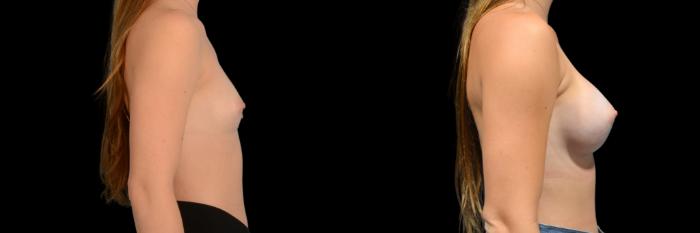 Before & After Breast Augmentation Case 833 Right Side View in Houston, TX