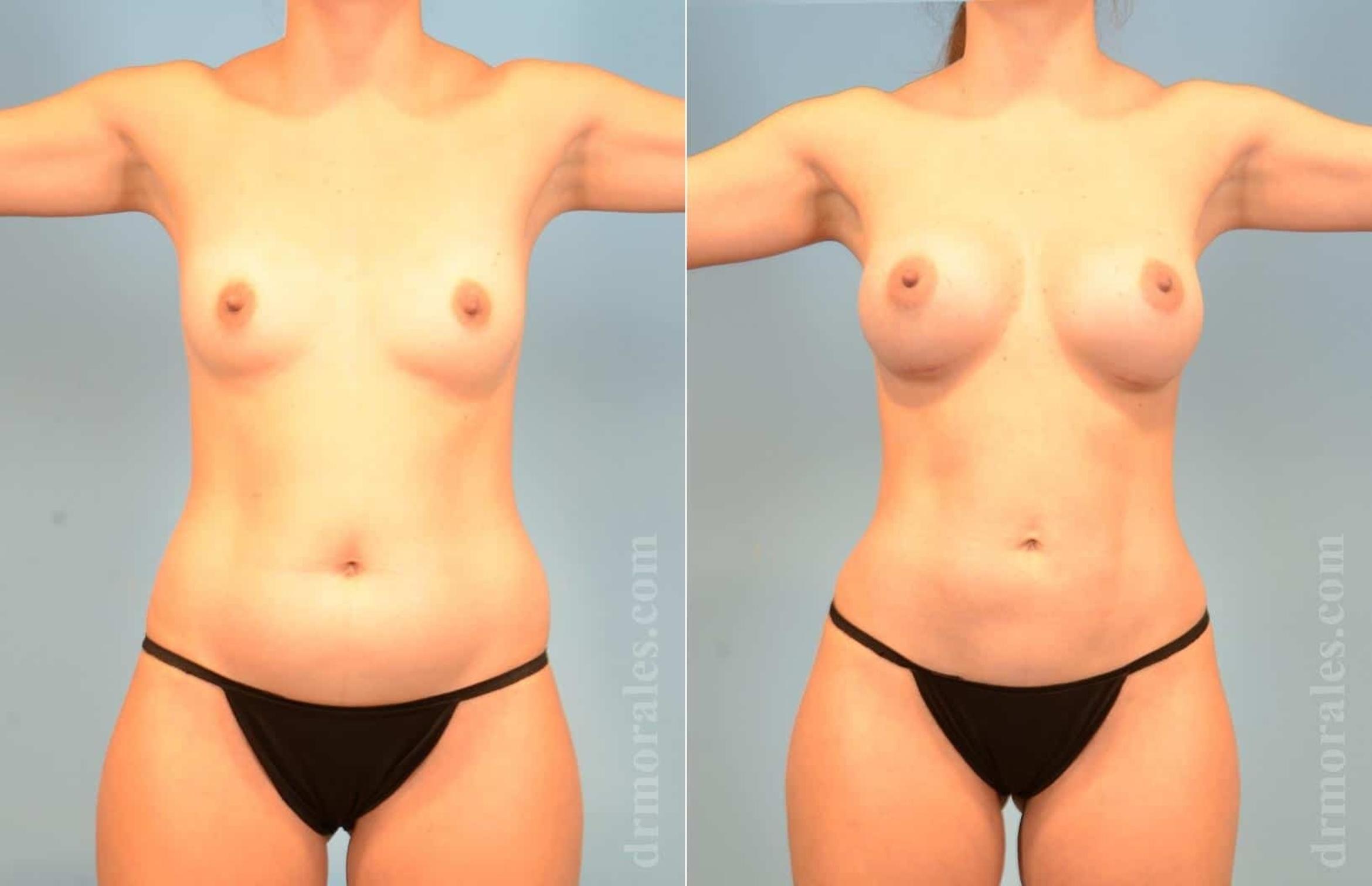 Before & After Liposuction Case 9 View 1 View in Houston, TX
