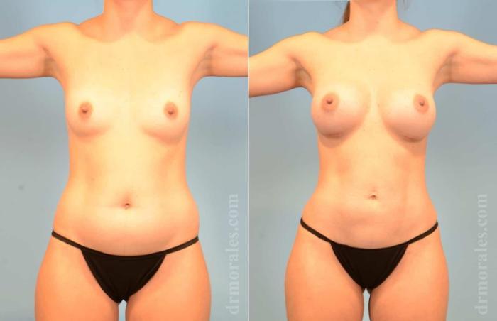 Before & After Liposuction Case 9 View 1 View in Houston, TX