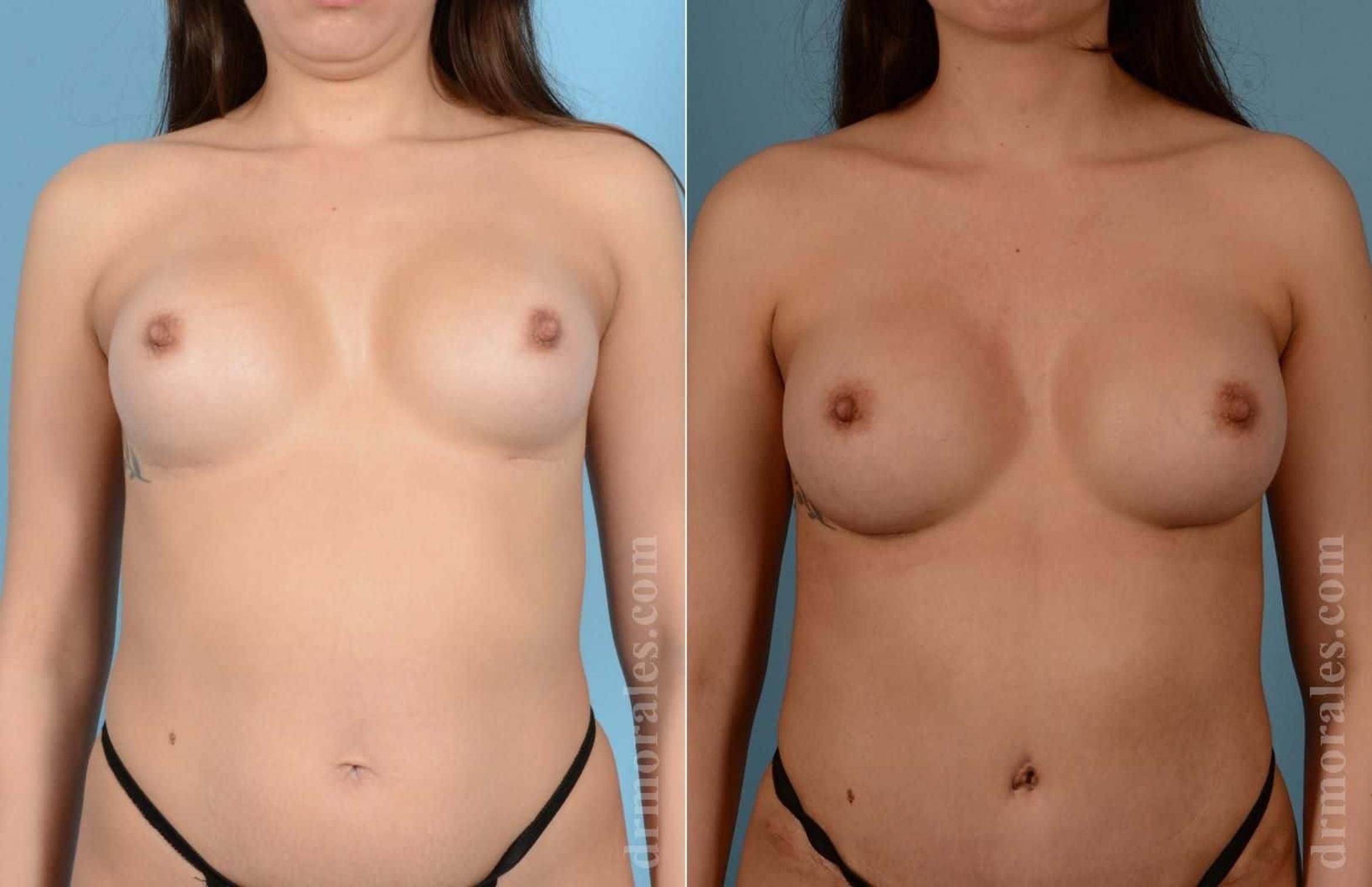 Before & After Breast Revision Case 90 View 1 View in Houston, TX