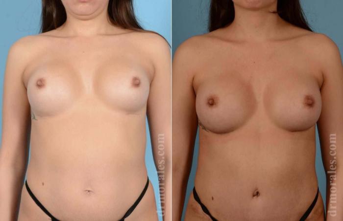 Before & After Breast Revision Case 90 View 1 View in Houston, TX