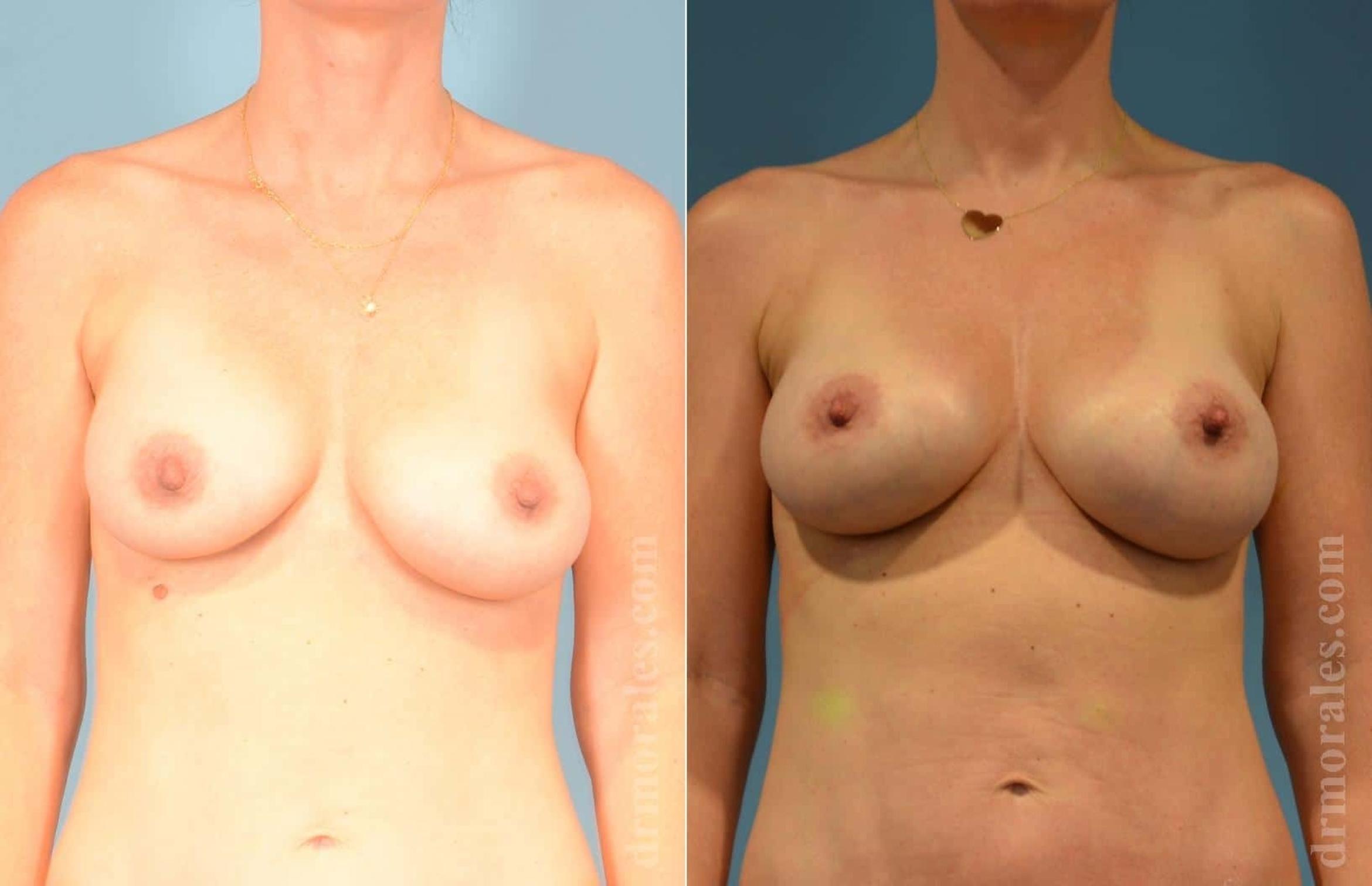Before & After Breast Augmentation With Lift Case 14 View 1 View in Houston, TX