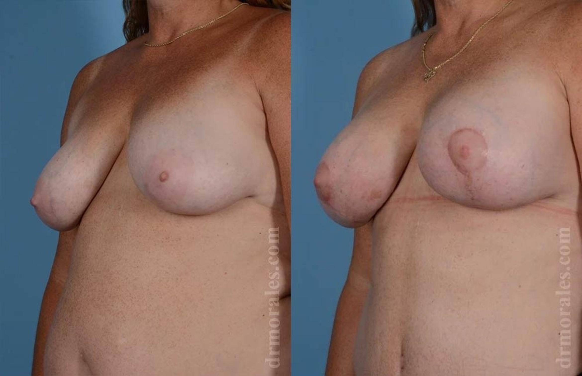 Before & After Breast Augmentation With Lift Case 581 View 1 View in Houston, TX