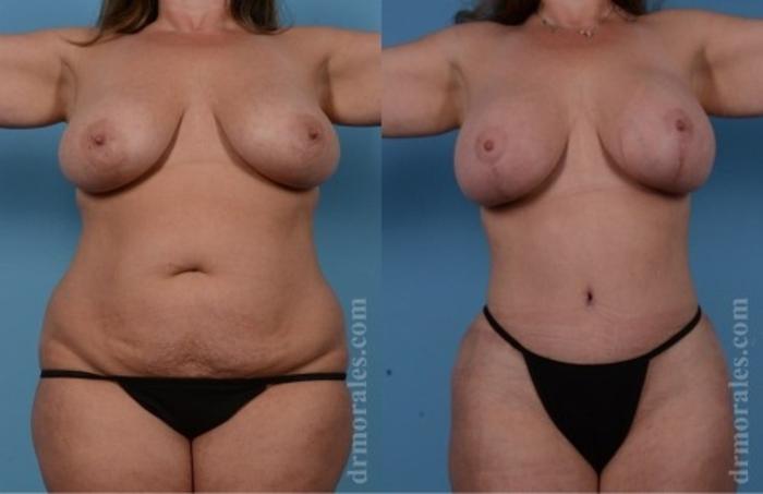 Before & After Breast Augmentation With Lift Case 646 View 1 View in Houston, TX