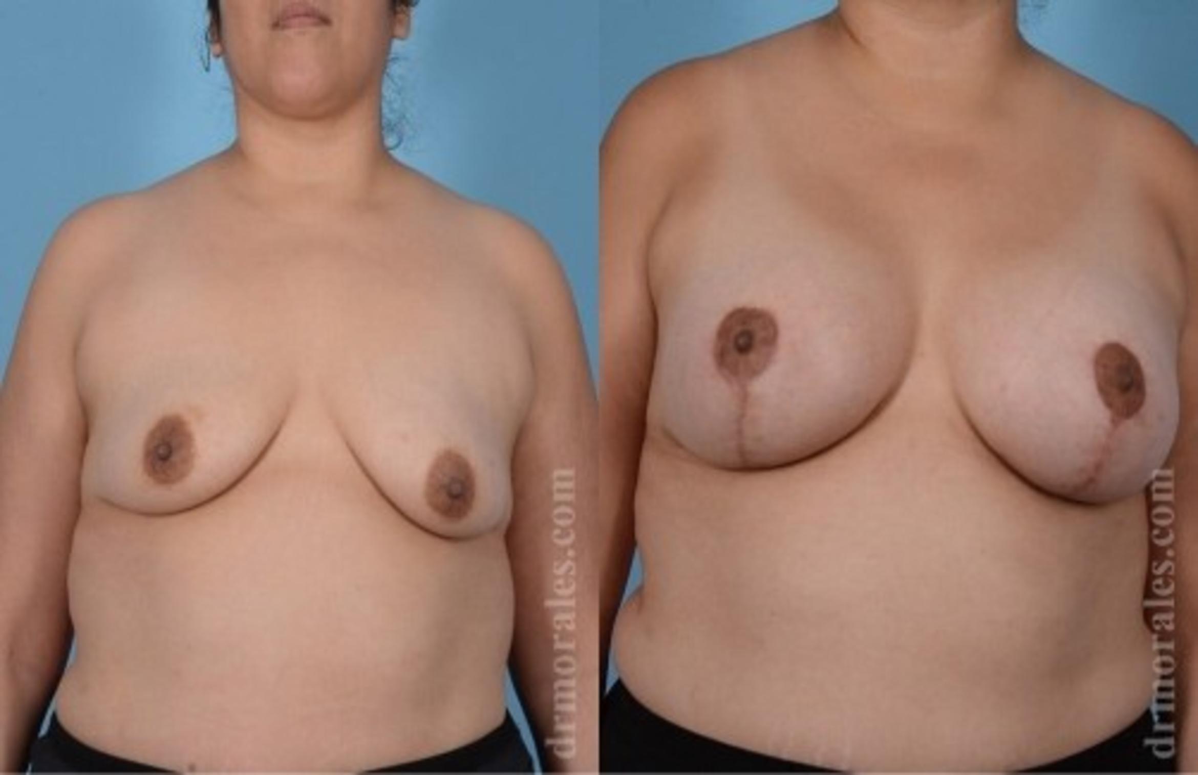 Before & After Breast Augmentation With Lift Case 647 View 1 View in Houston, TX