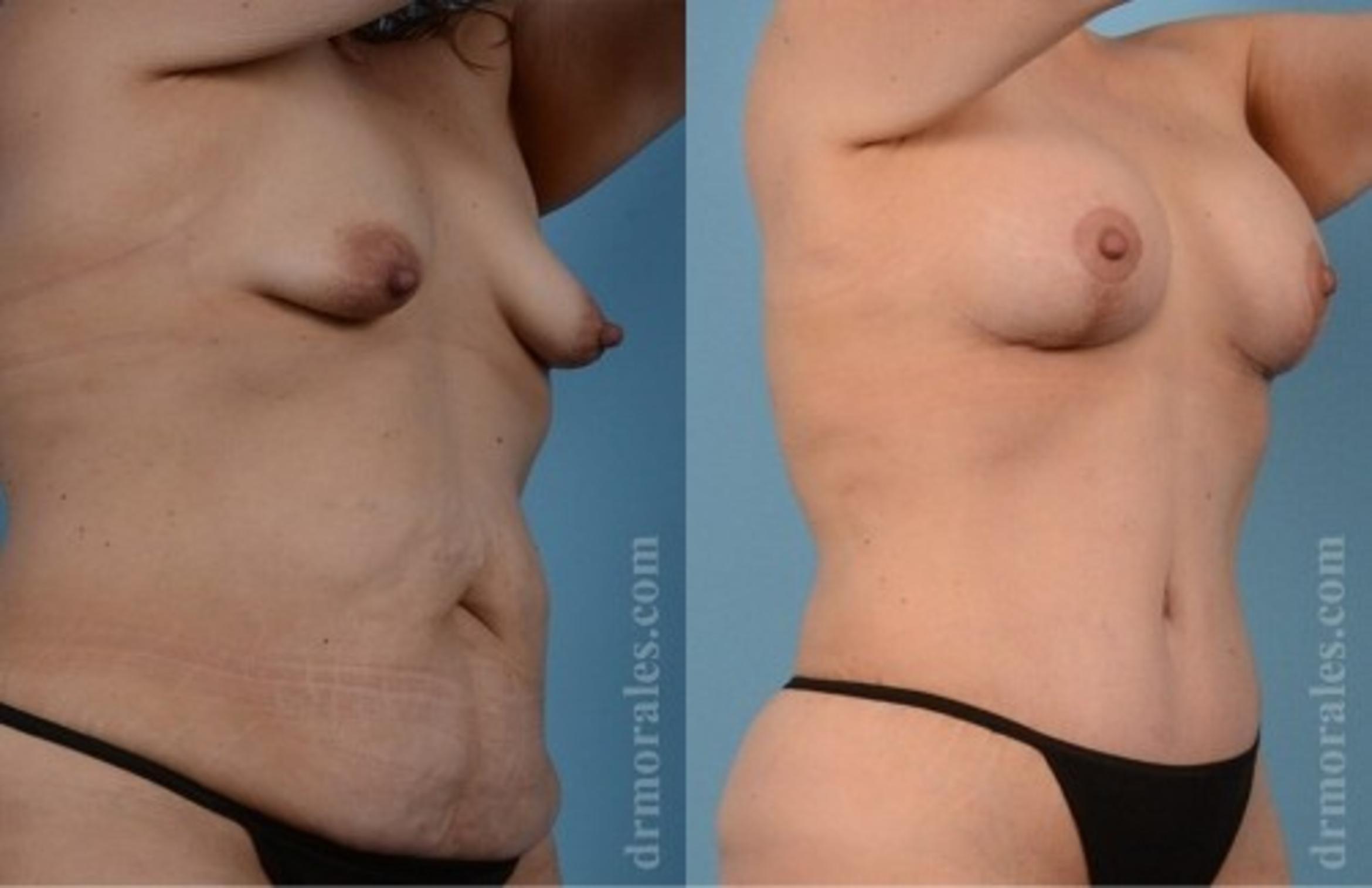 Before & After Breast Augmentation With Lift Case 648 View 1 View in Houston, TX