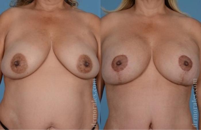 Before & After Breast Augmentation With Lift Case 649 View 1 View in Houston, TX