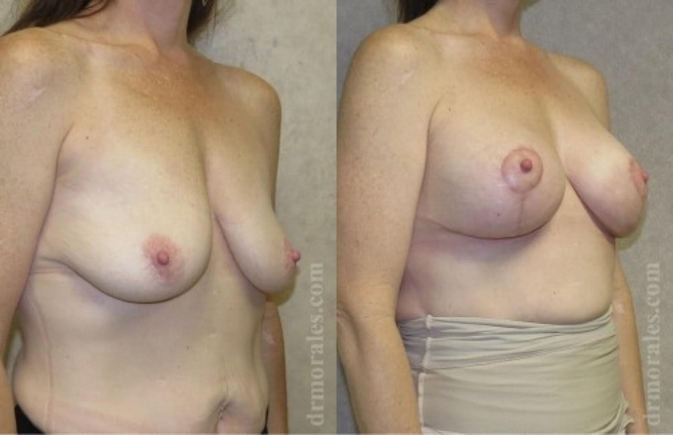 Before & After Breast Augmentation With Lift Case 650 View 1 View in Houston, TX