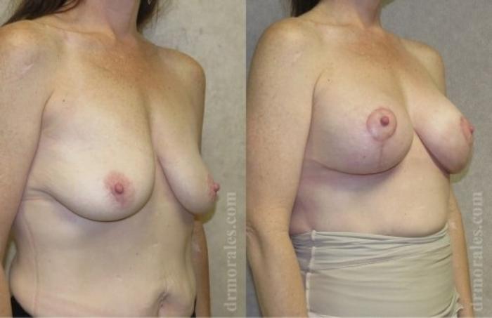 Before & After Breast Augmentation With Lift Case 650 View 1 View in Houston, TX