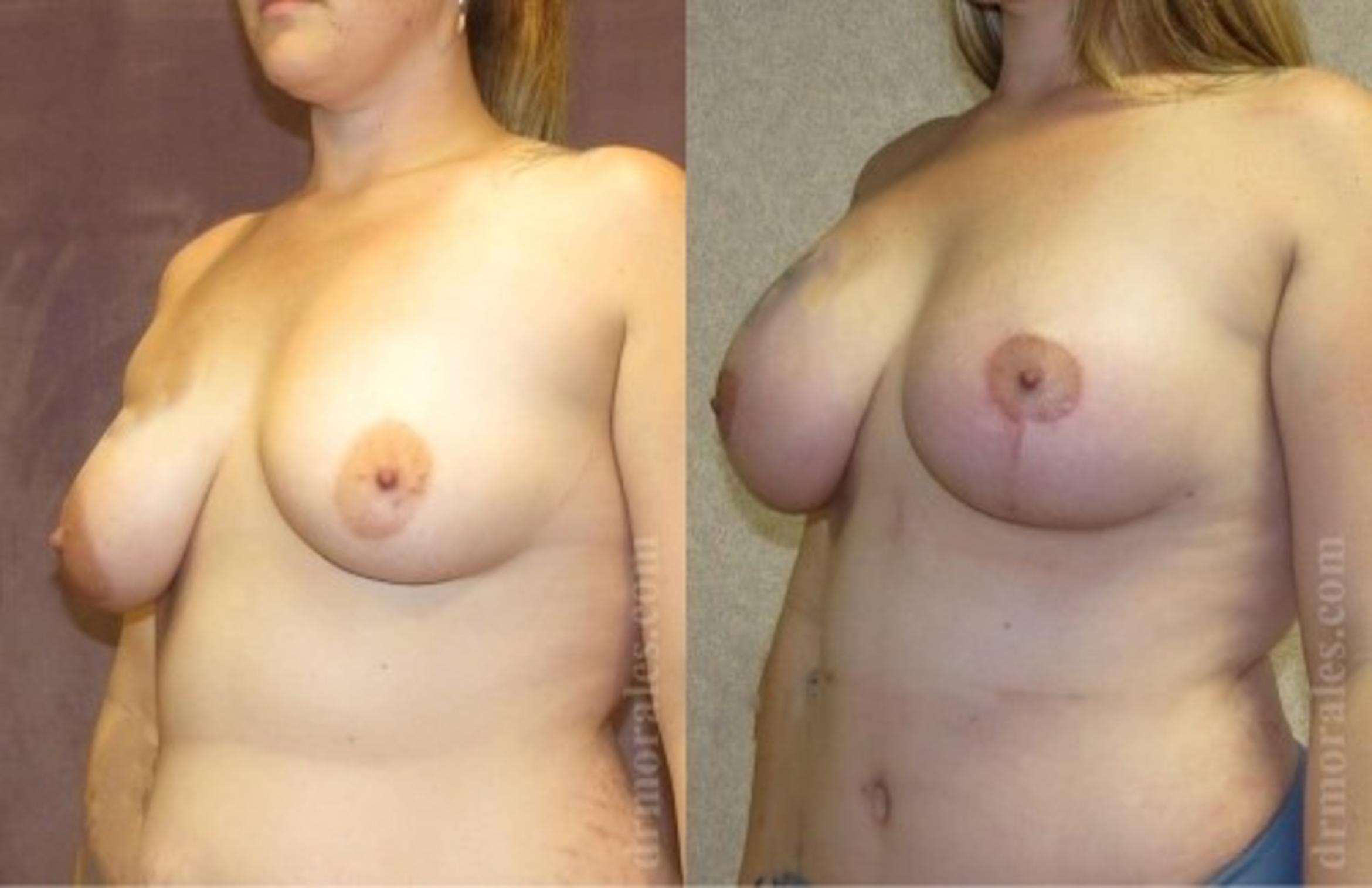 Before & After Breast Augmentation With Lift Case 651 View 1 View in Houston, TX