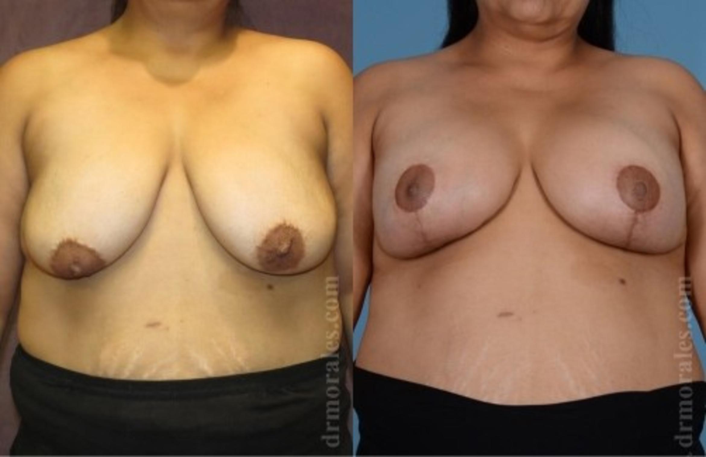 Before & After Breast Augmentation With Lift Case 652 View 1 View in Houston, TX