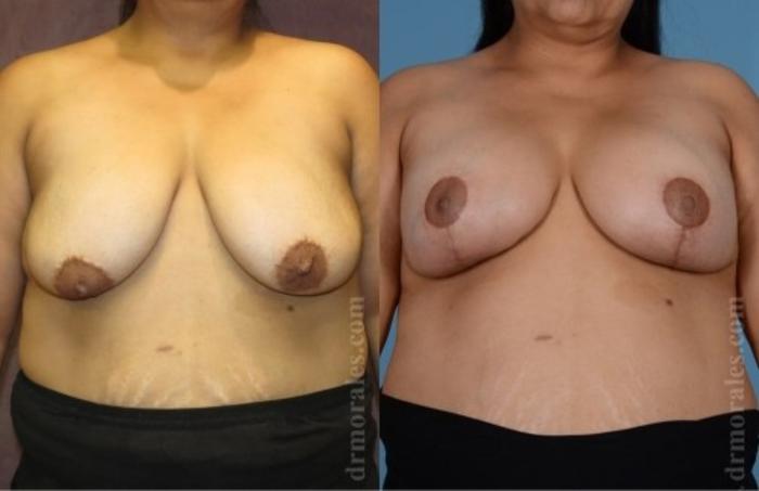 Before & After Breast Augmentation With Lift Case 652 View 1 View in Houston, TX