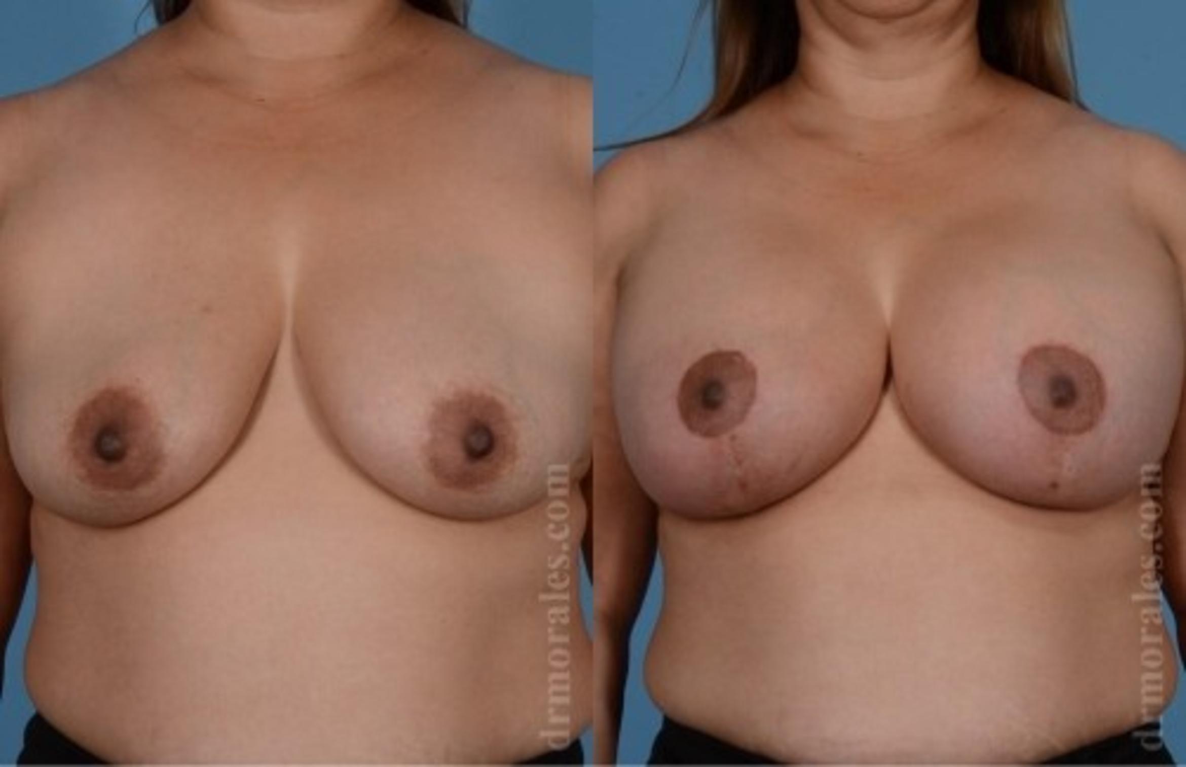 Before & After Breast Augmentation With Lift Case 654 View 1 View in Houston, TX