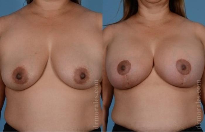 Before & After Breast Augmentation With Lift Case 654 View 1 View in Houston, TX