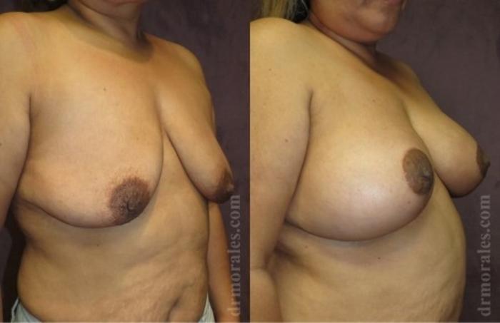 Before & After Breast Augmentation With Lift Case 655 View 1 View in Houston, TX