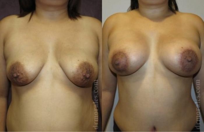 Before & After Breast Augmentation With Lift Case 656 View 1 View in Houston, TX