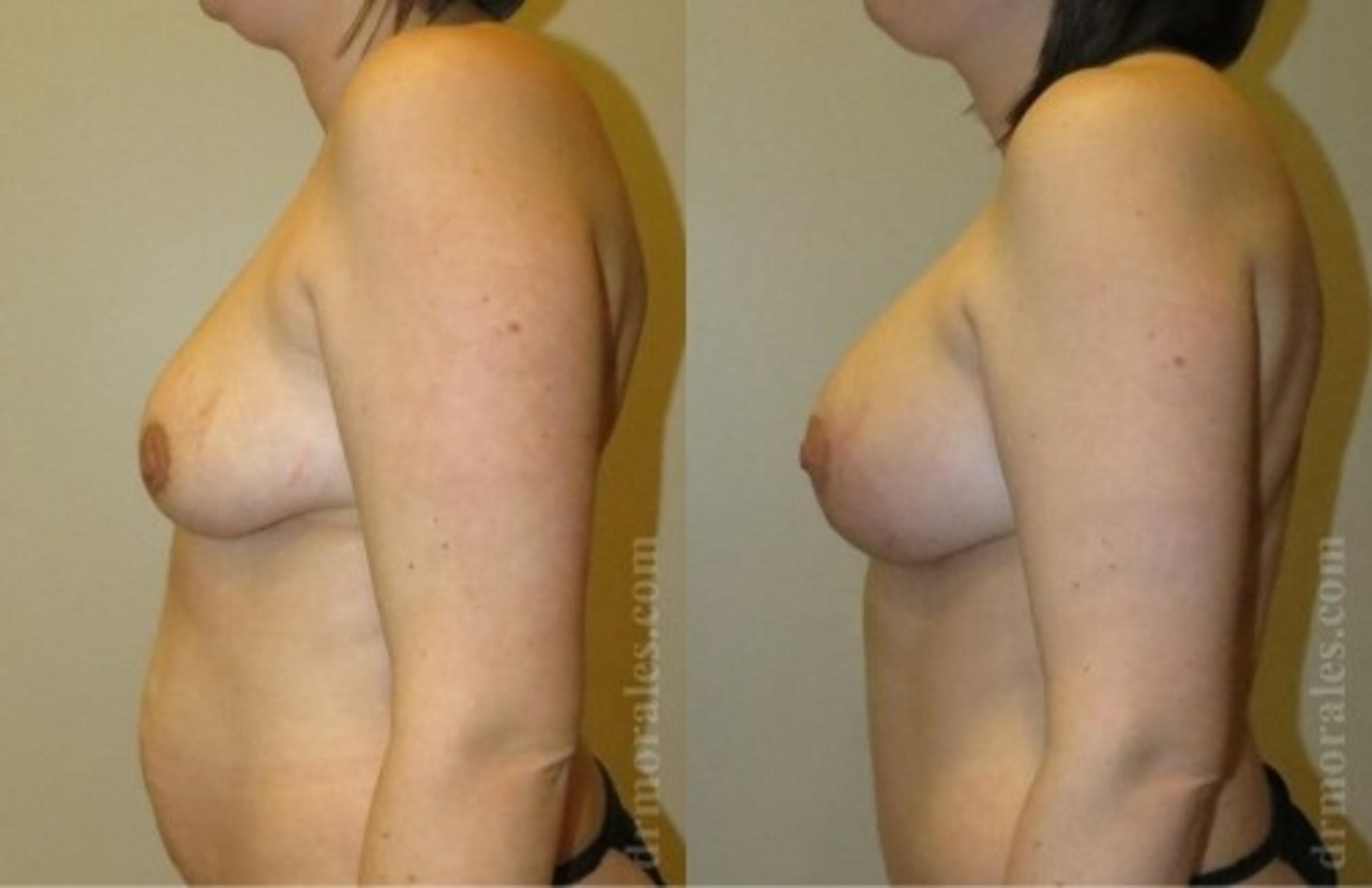 Before & After Breast Augmentation With Lift Case 657 View 1 View in Houston, TX