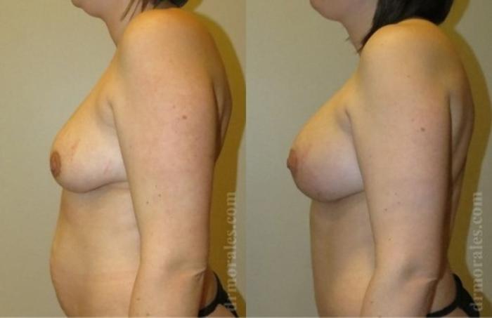 Before & After Breast Augmentation With Lift Case 657 View 1 View in Houston, TX