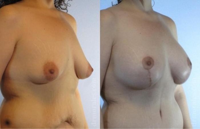 Before & After Breast Augmentation With Lift Case 658 View 1 View in Houston, TX