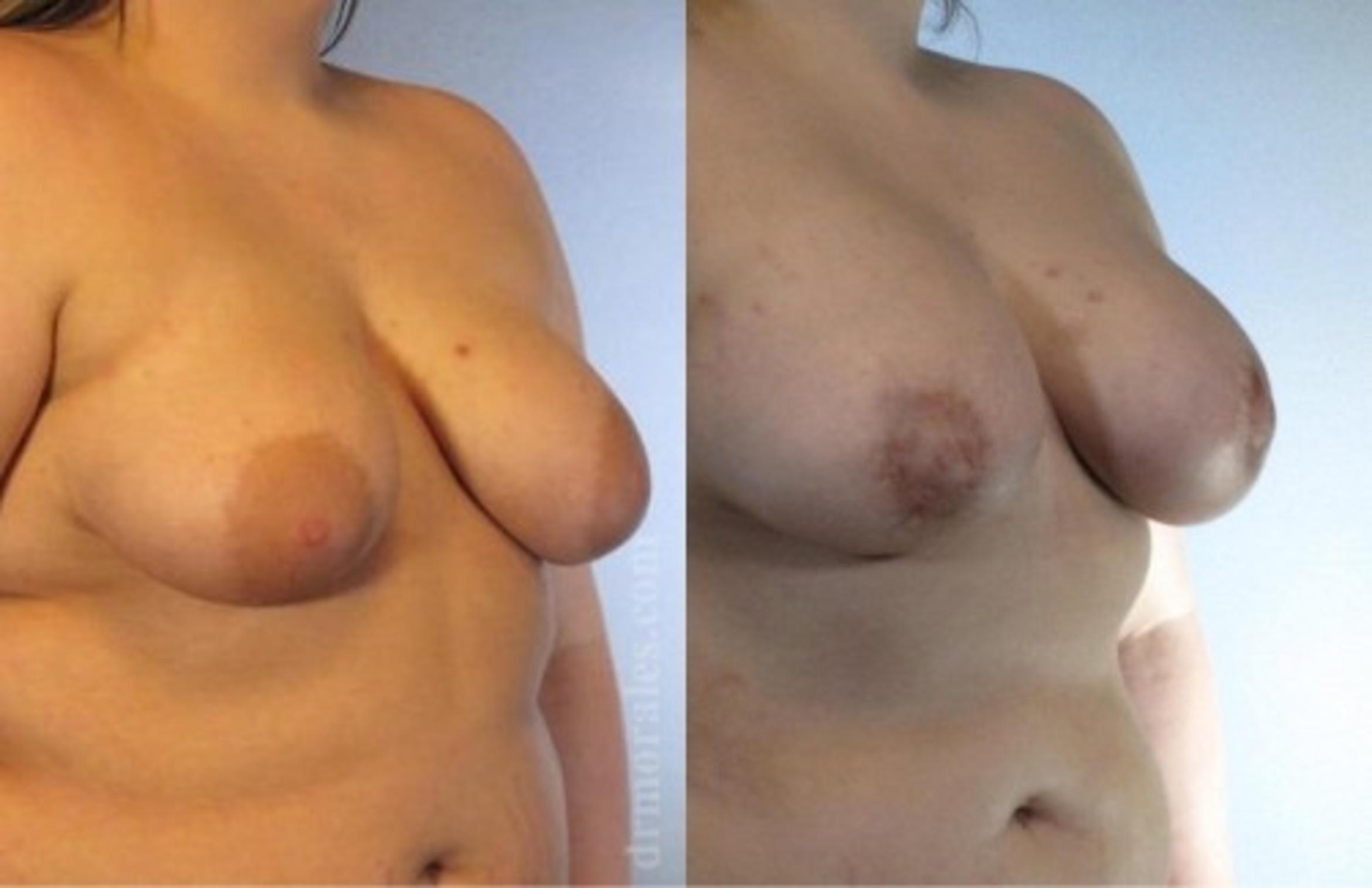 Before & After Breast Augmentation With Lift Case 659 View 1 View in Houston, TX