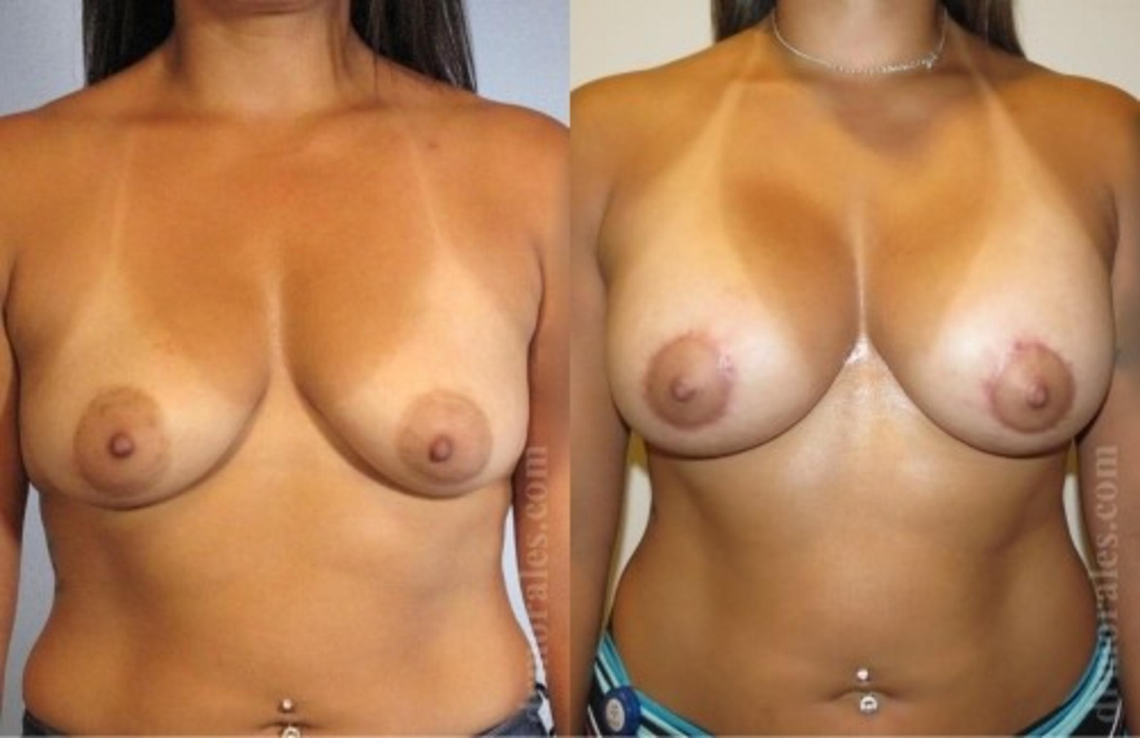 Before & After Breast Augmentation With Lift Case 660 View 1 View in Houston, TX