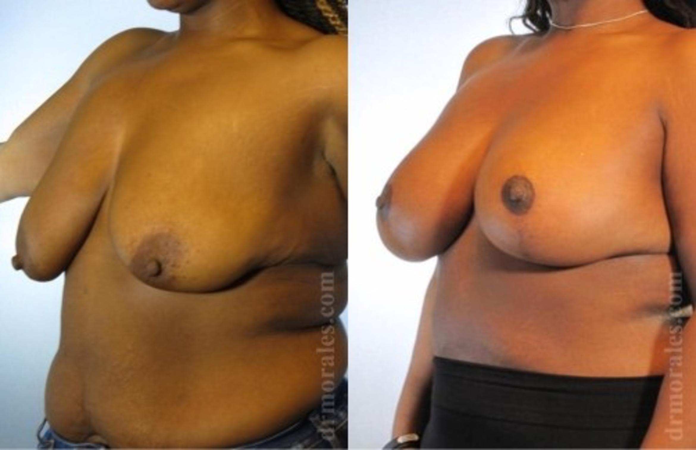 Before & After Breast Augmentation With Lift Case 662 View 1 View in Houston, TX