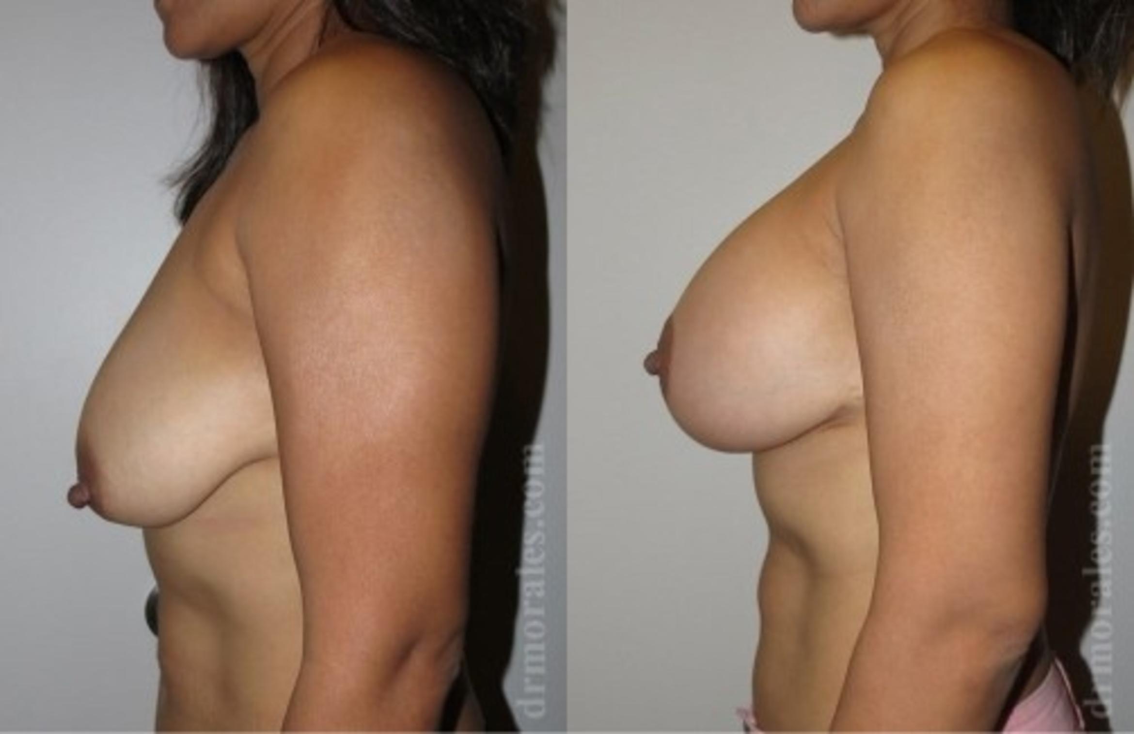 Before & After Breast Augmentation With Lift Case 664 View 1 View in Houston, TX