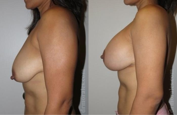 Before & After Breast Augmentation With Lift Case 664 View 1 View in Houston, TX
