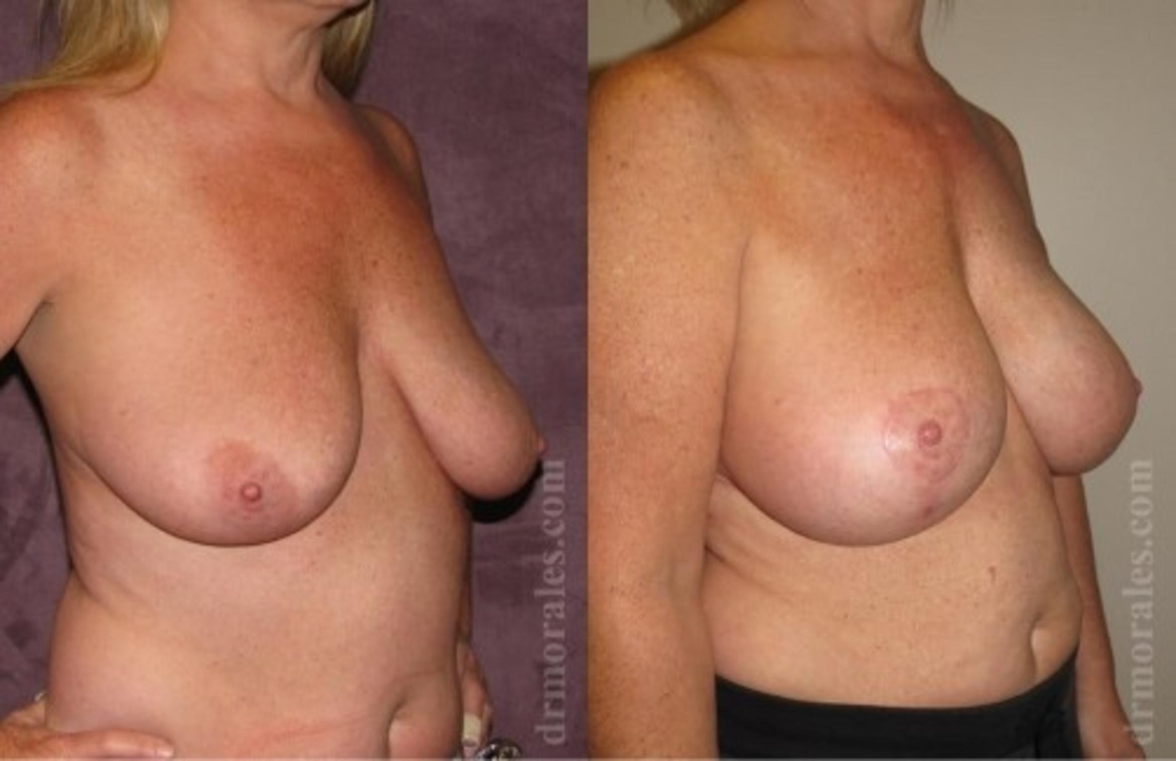 Before & After Breast Augmentation With Lift Case 665 View 1 View in Houston, TX