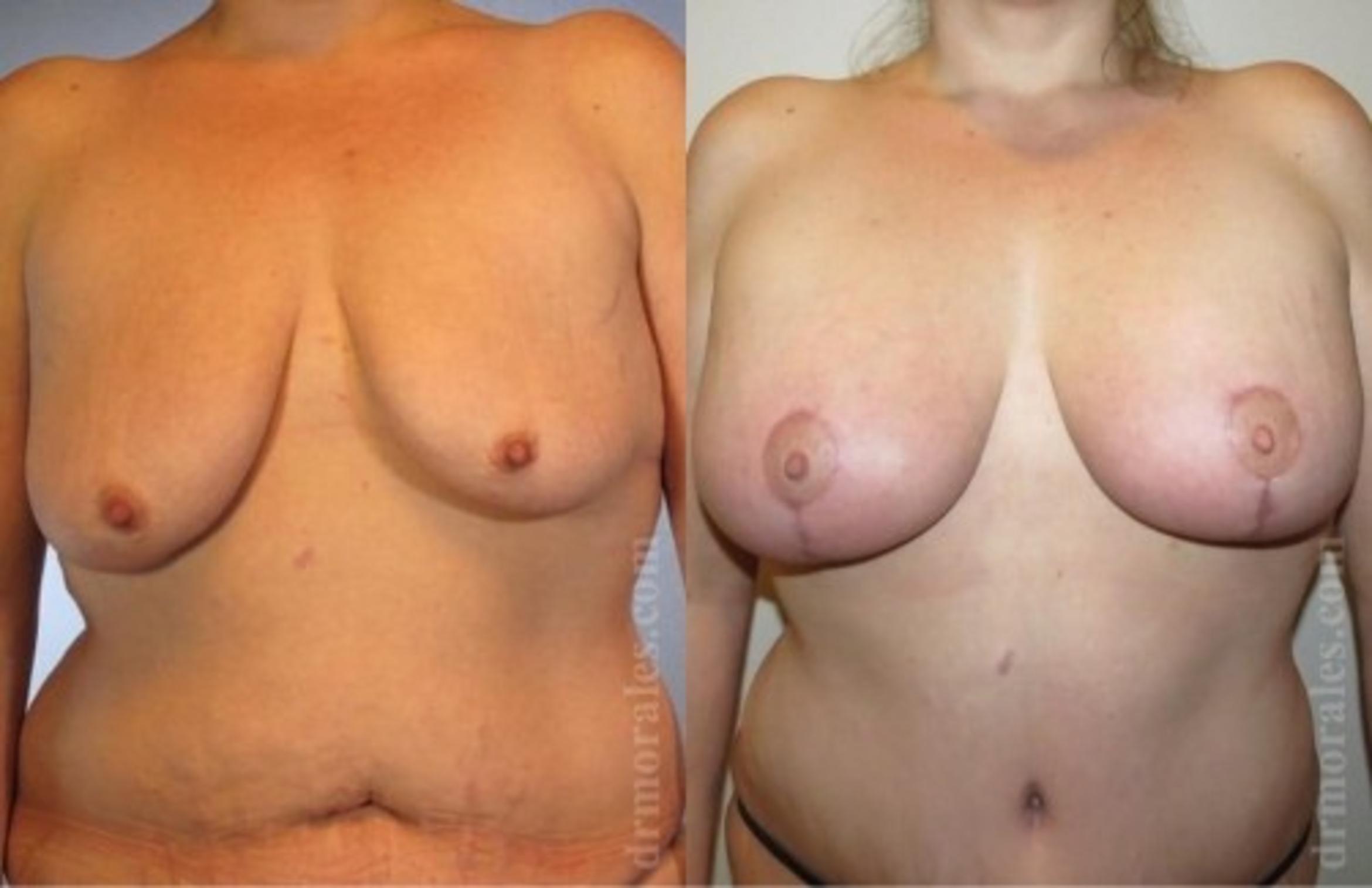 Before & After Breast Augmentation With Lift Case 666 View 1 View in Houston, TX
