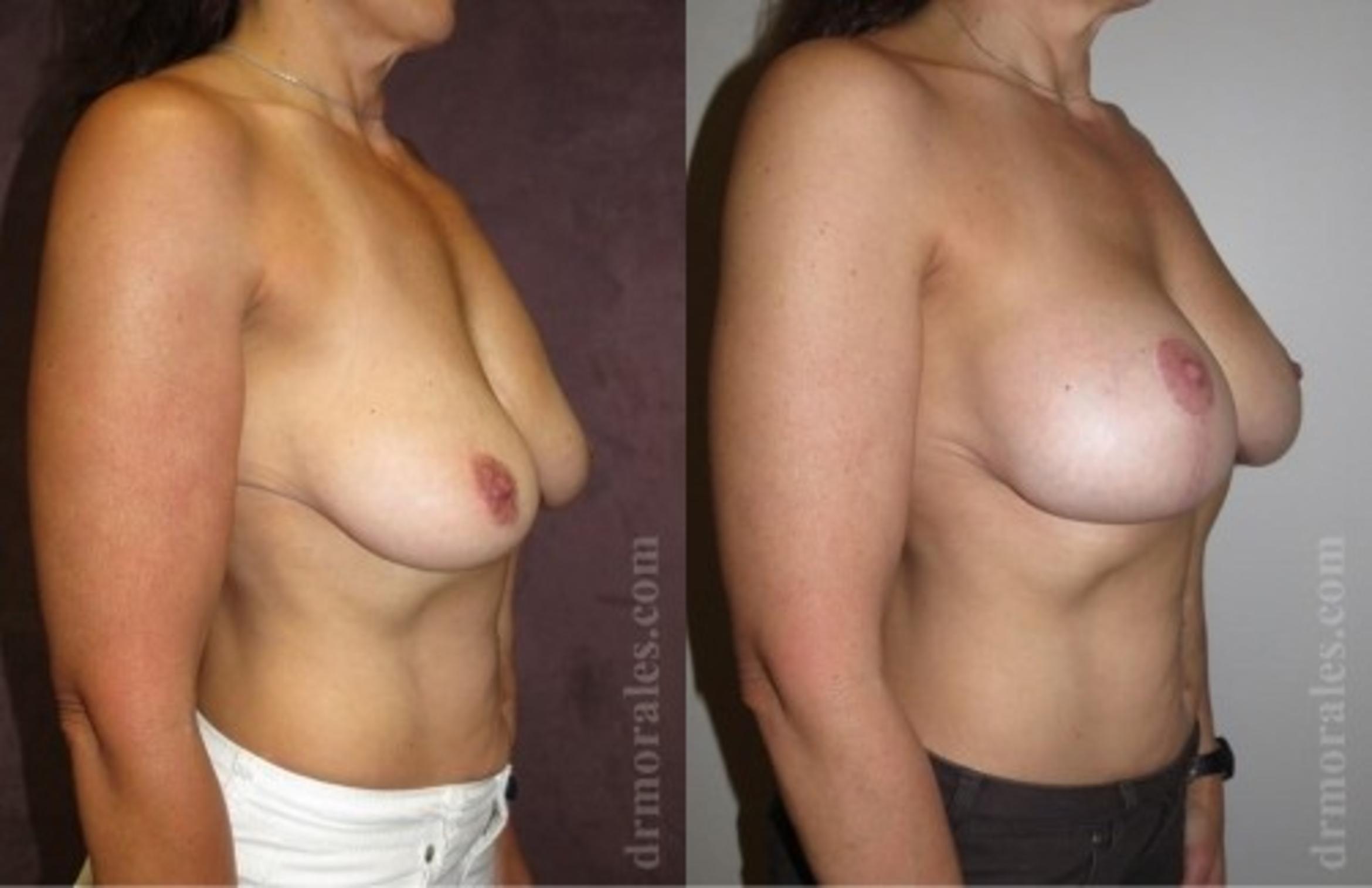 Before & After Breast Augmentation With Lift Case 667 View 1 View in Houston, TX