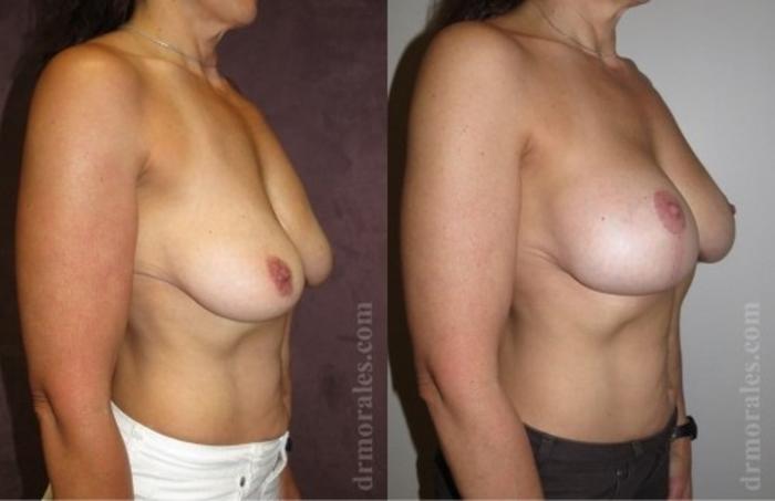Before & After Breast Augmentation With Lift Case 667 View 1 View in Houston, TX