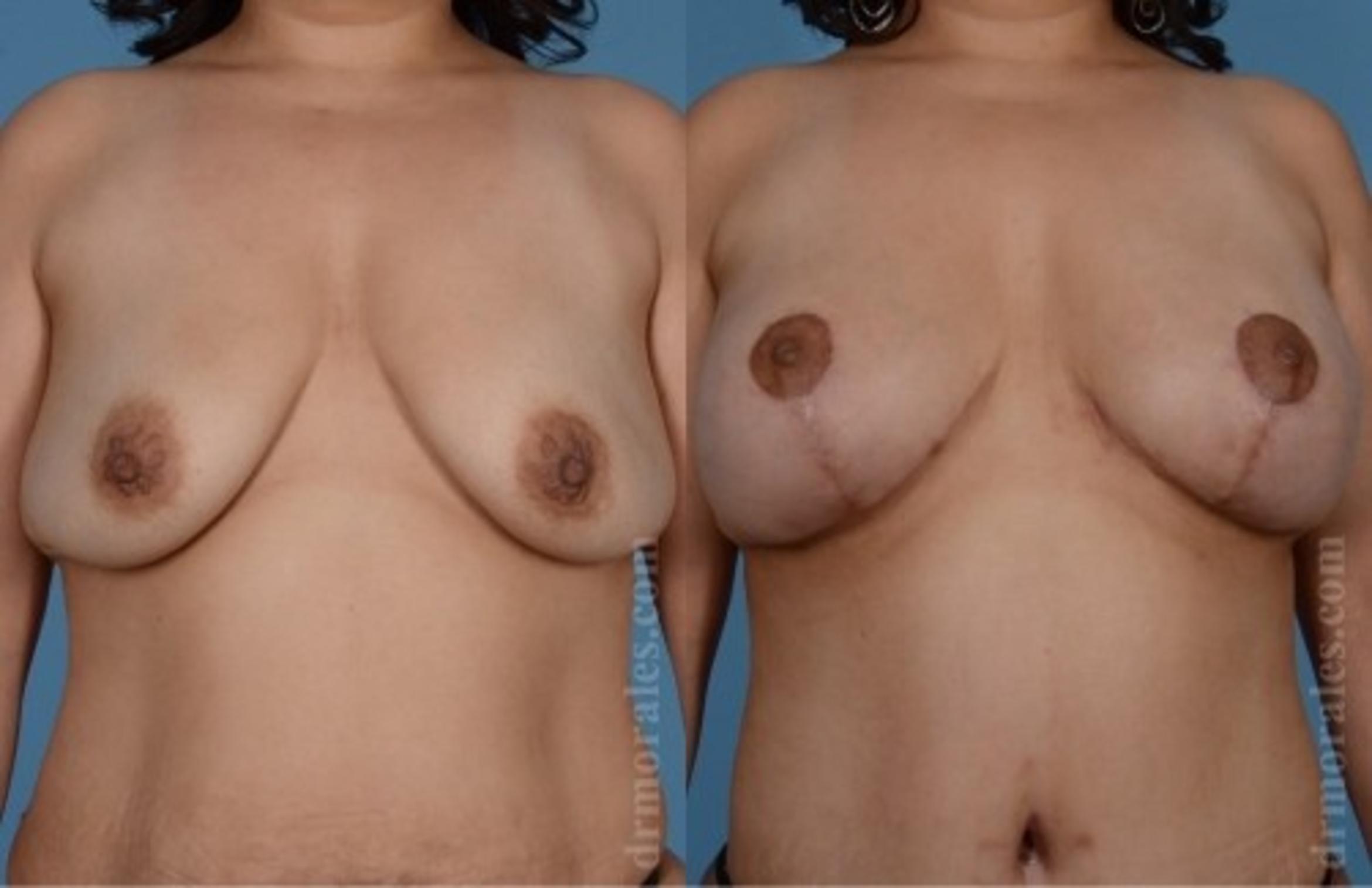 Before & After Breast Augmentation With Lift Case 668 View 1 View in Houston, TX